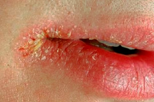 Почему возникают трещинки в уголках губ