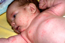 Пищевая аллергия у малышей. Причины